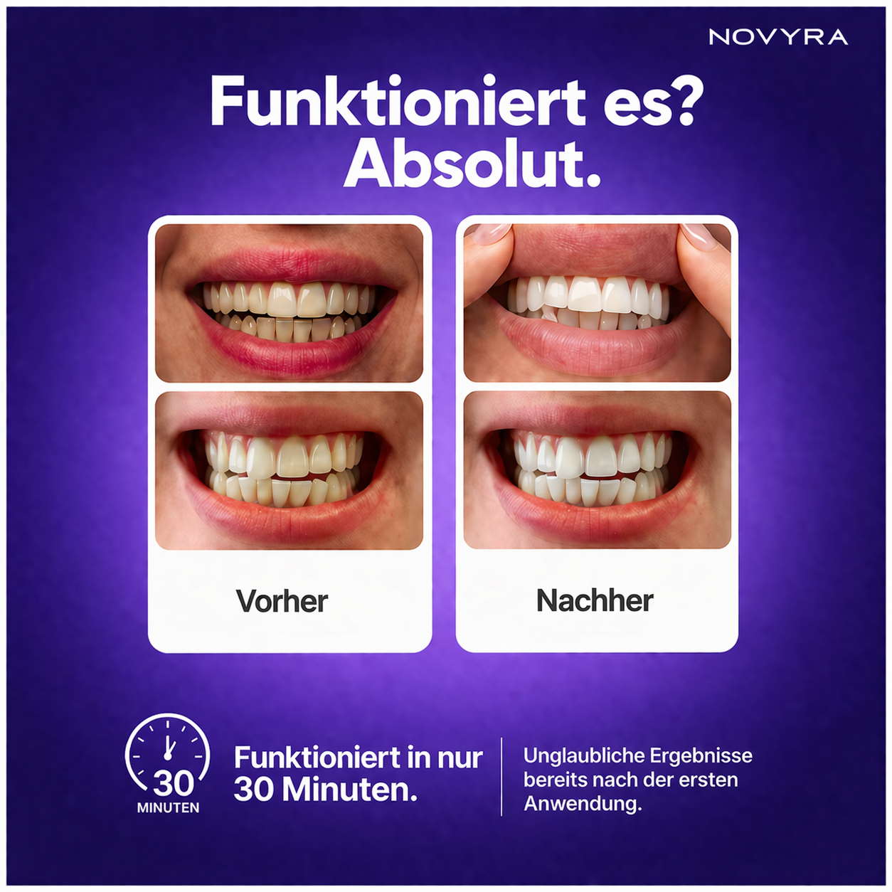 Whitening Strips